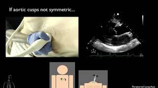 03. Parasternal Long Axis View