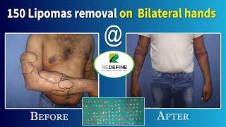 Multiple Lipomas Removal @ Redefine Plastic Surgery Centre || Dr Hari Kiran Chekuri || 92371 23456