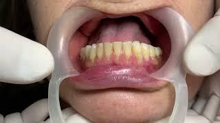 HOW to replace teeth with FLEXIBLE DENTAL PROSTHESES