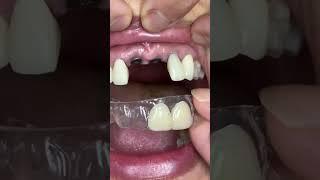 For temporary teeth for implants!