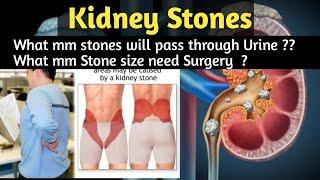 Kidney Stones Causes, Symptoms and Treatment.