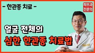 [피부과 전문의] 얼굴 전체로 퍼진 심한 한관종 치료법