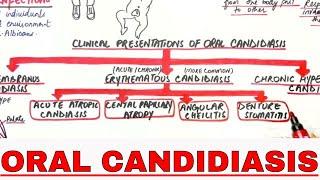 Oral Candidiasis - Causes, Clinical presentations, Treatment