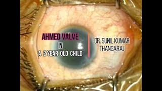 Ahmed Valve (valved seton ) in a 2 yr old child with Intractable Glaucoma following Lensectomy