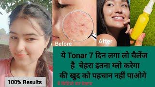 Challenge है, 7 दिन ये Tonar   लगा लो।चेहरा इतना ग्लो करेगा की खुद को पहचान नहीं पाओगे,skin Glowing