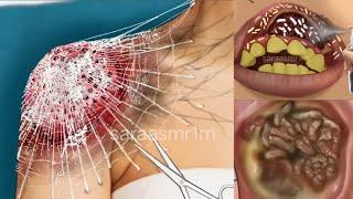 ASMR Remove Big Acne & Worm Infected Back | Deep Cleaning Animation