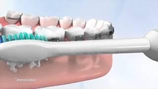 Tips on how use a Philips Sonicare toothbrush with braces. Hygiene is a key part of daily care.