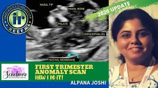 FIRST TRIMESTER ANOMALY SCAN | How I do it by Alpana Joshi | FETAL IMAGING | NASAL BONE & NT