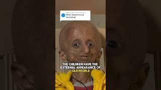 What is Progeria?
