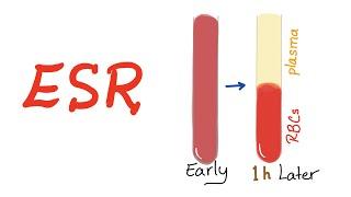 Erythrocyte Sedimentation Rate (ESR); What Does This Lab Test Really Mean?