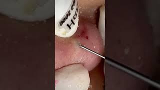 Skincare | Blackheads Removal #486 #tweezers skincare #blackheads blackheads