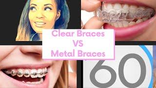 Smile Direct Vs Metal Braces : 60 second Dental Answers with Dr. Denis the Dentist