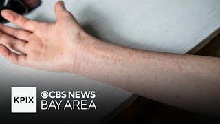 Potential measles exposure in two Bay Area counties