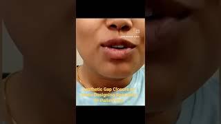 Smile Correction ️ #smile #smilemakeover #teethwhitening #drsouravbanerjee #trending #shorts #viral