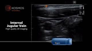 Kosmos by EchoNous for Vascular Access Ultrasound Capabilities