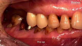 Dentium - Multiple implant placement by Pf. Jung Chul Park