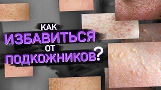 Подкожники. Что такое и как от них избавиться?