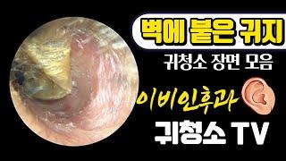 벽에 붙은 귀지 제거 (cerumen removal) 귀청소 장면 모음