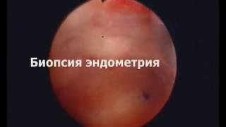 Офисная гистероскопия. Биопсия эндометрия.