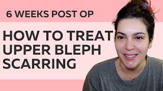 6 WEEKS POST OP UPPER BLEPHAROPLASTY SCARS & HOW TO TREAT THEM (before & after photos too)