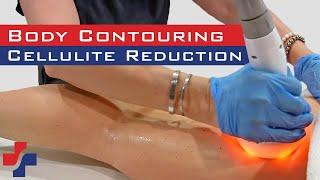 Body Contouring and Cellulite Reduction with the Most Popular Radio-Frequency Device