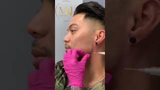 Jawline Fillers Course