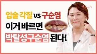 단순 건조? 박탈성 구순염? 입술 증상 감별 포인트 & 관리법