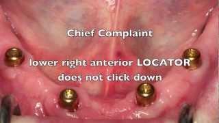 NEW! Locator Dental  Implant Attachments - Workshop Tips