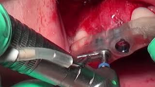 Computer Guided Implant Placement 2 (Adin) , after GBR - by Dr Bernard Dahan