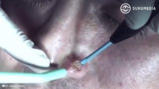 Scarless Mole Removal, is it possible?