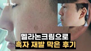 멜라논크림으로 1년 만에 생긴 흑자 재발 없앤 후기! 멜라논크림 효능 효과