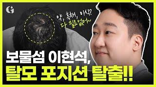 "이젠 탈모 아니야!!" 보물섬 이현석의 탈모 해결법  feat.두피문신