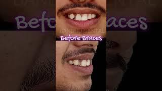 Want a Great Smile?#bracesbeforeandafter #fullmouthdentalimplants #dentalimplants