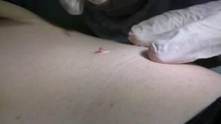Rimozione fibroma pendulo