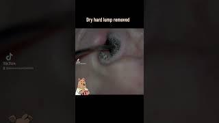 Hard dry wax lump removed from ear #ear #earwax #earwaxremoval #earcarespecialists #cerumen