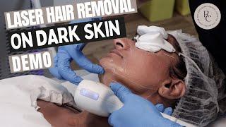 Laser Hair Removal On Darker Skin (Fitzpatrick Skin type 5) - Demonstration/Tutorial | What To Know