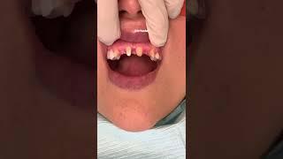 can dental bridges look good? | Dental bridge procedure | missing front tooth fix | Dr. Yazdan