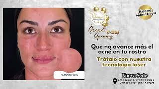 Tratamiento ACNÉ cicatríz #Tratamientoacne #tratamientofacial #bellezaeterna #palomaclinicspa