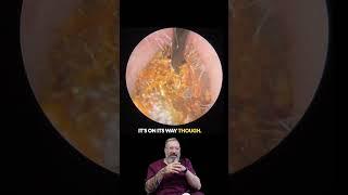 UNBELIEVABLE Ear Wax Plug! Huge One Piece Removal 