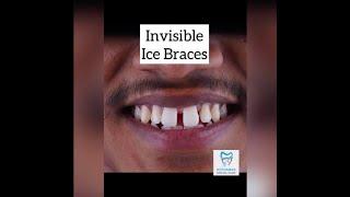 How braces are put on - Crystal clear braces #shorts