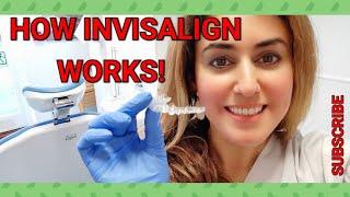 How Invisalign Braces Work- Explained By Orthodontist! | Best Invisalign Facts
