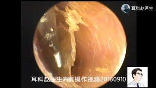 Two forms of fungal otitis externa, 两种形态的真菌性外耳道炎