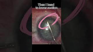 SmartSight lenticule extraction technique - keyhole laser eye surgery