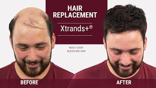 Hair Loss in Your 20s - There is a solution [ Hair replacement transformation ]