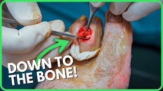  92-Year-Old Patient Faces Life-Changing Foot Surgery | Can We Save Her Toe?