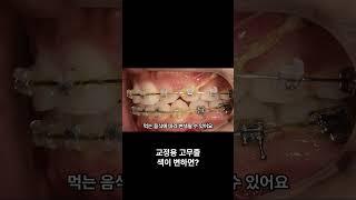 교정용 고무줄 색이 변했어요 ㅠㅠ   #교정중생기는 #쇼츠