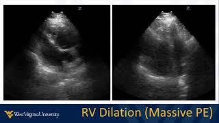 POCUS in Acute Dyspnea 3 - Cardiovascular Causes