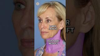 Gorgeous Mini Facelift Results #cosmeticsurgery #antiaging #goviral #beforeandafter