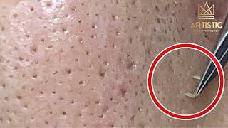 กดสิว blackheads filaments on nose remove with tweezers