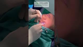 PRK Surgery Live | Eye care Hyderabad